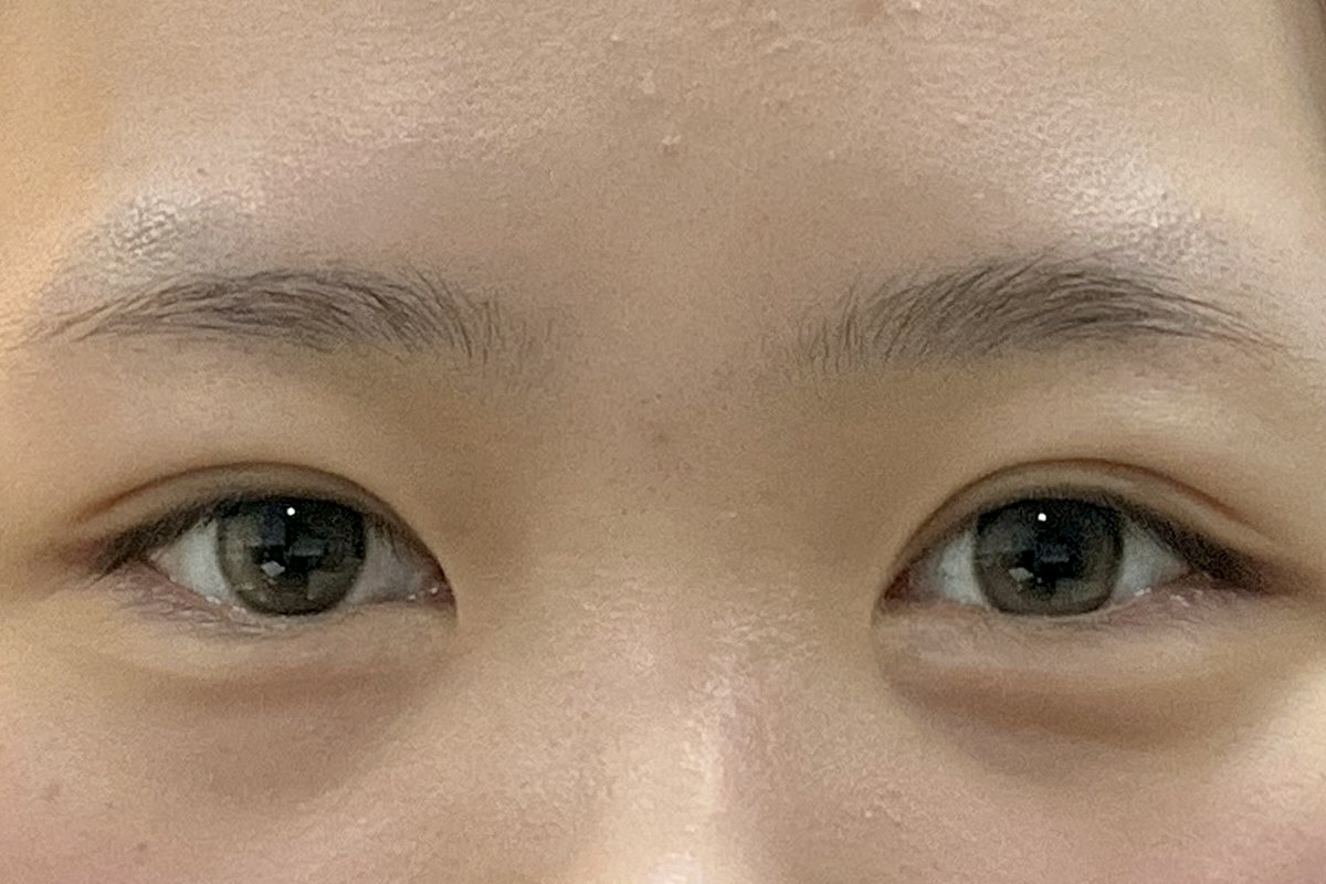 쌍꺼풀 절개 수술 후