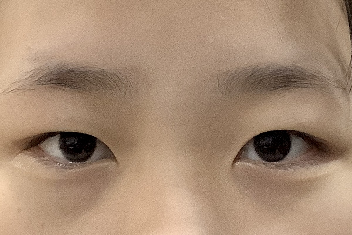 쌍꺼풀 절개 수술 전