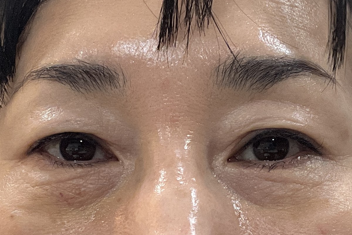 쌍꺼풀 매몰 수술 전