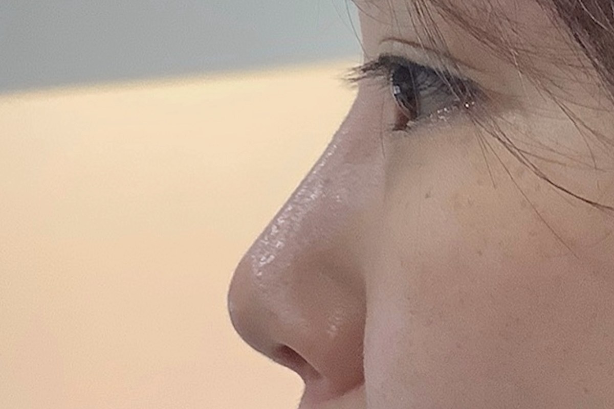 코끝 성형 후