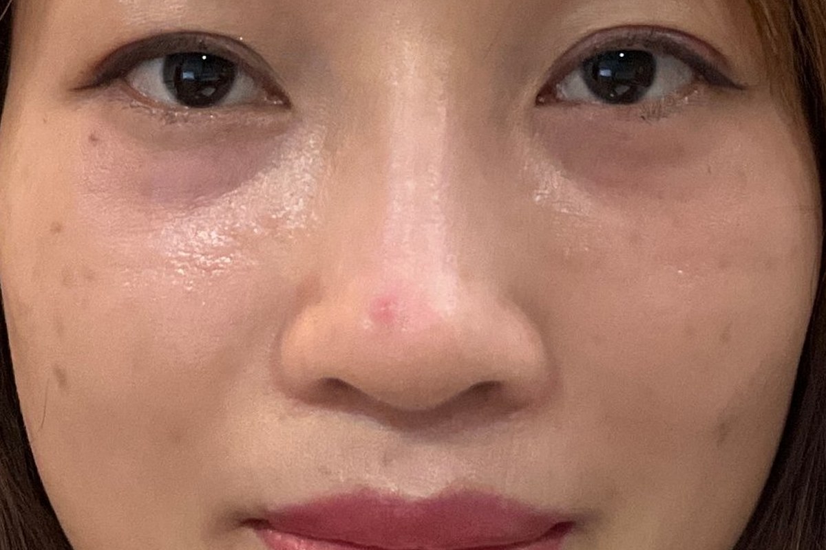 코끝 · 콧대 성형 정면 후