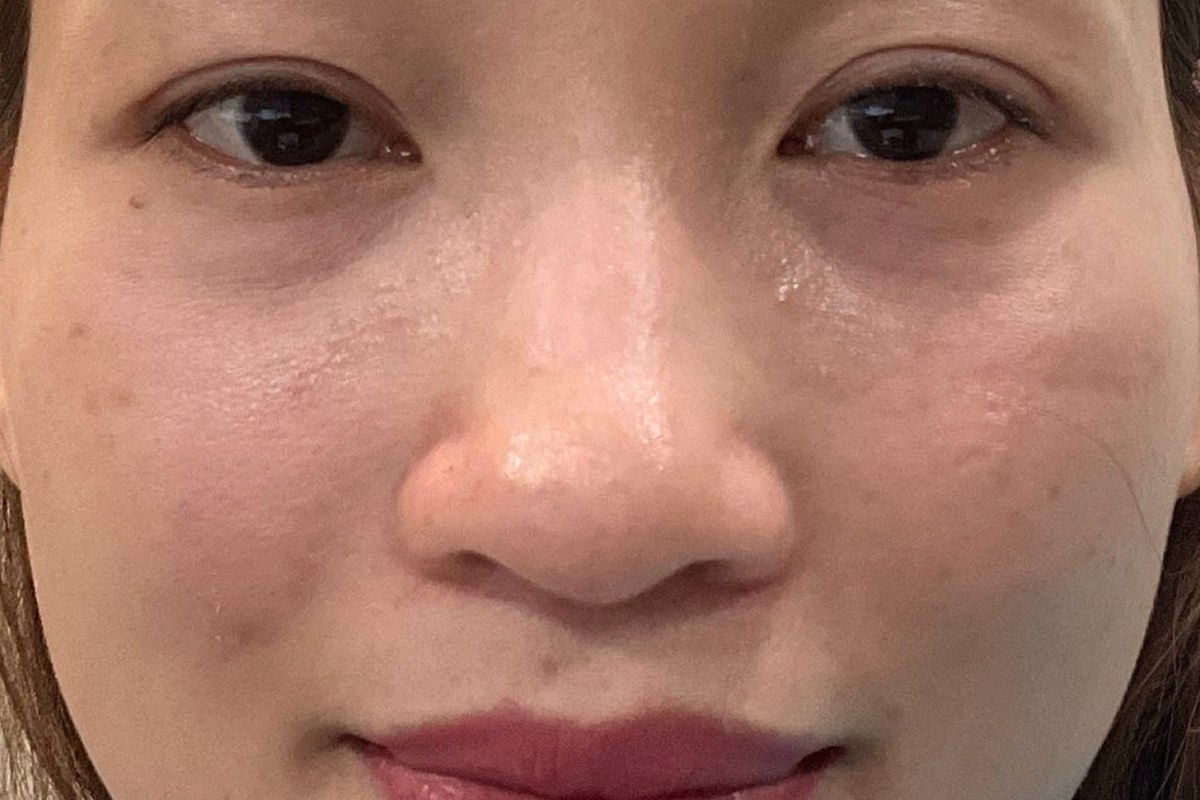 코끝 · 콧대 성형 정면 전