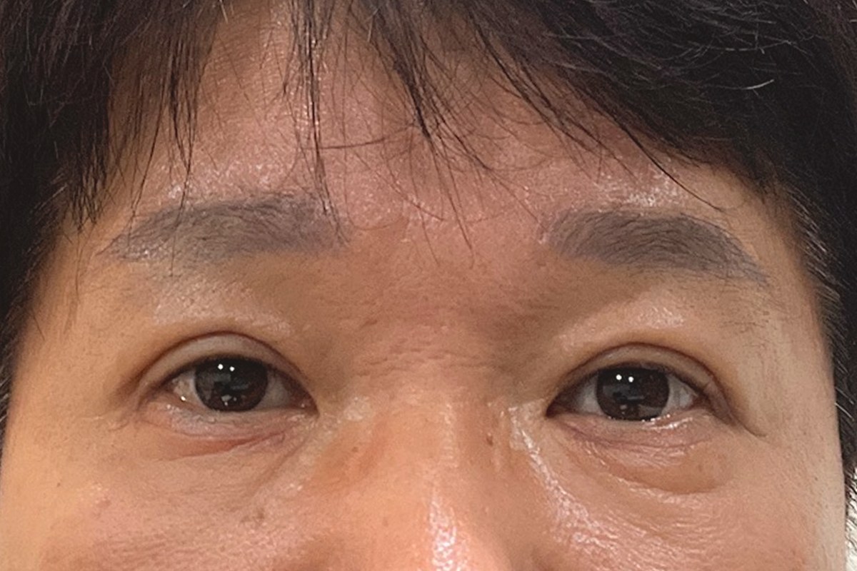 상안검성형 후