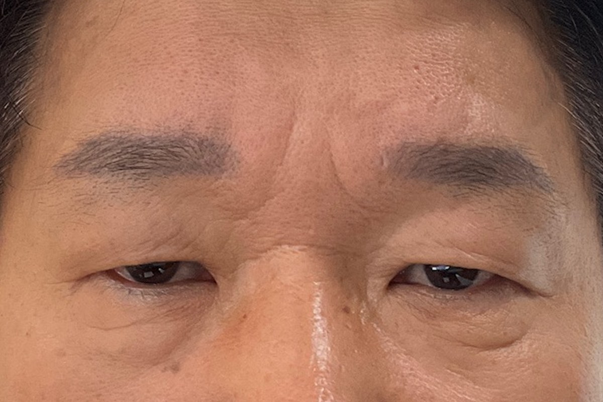 상안검성형 전