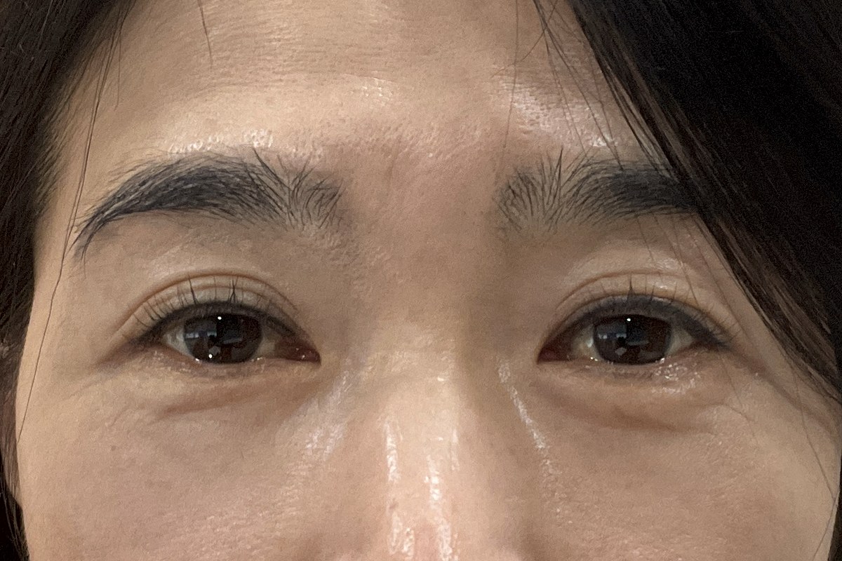 하안검 수술 후