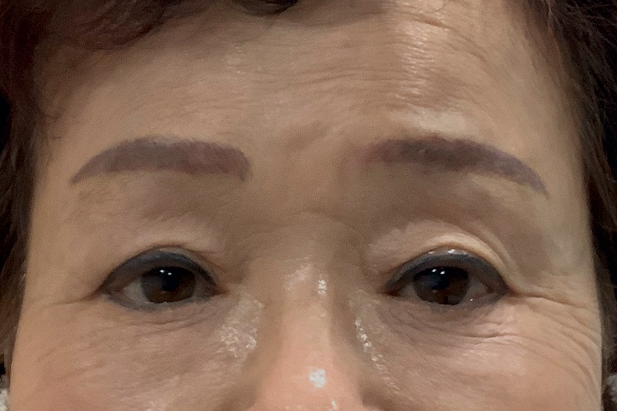 안검하수 교정 후