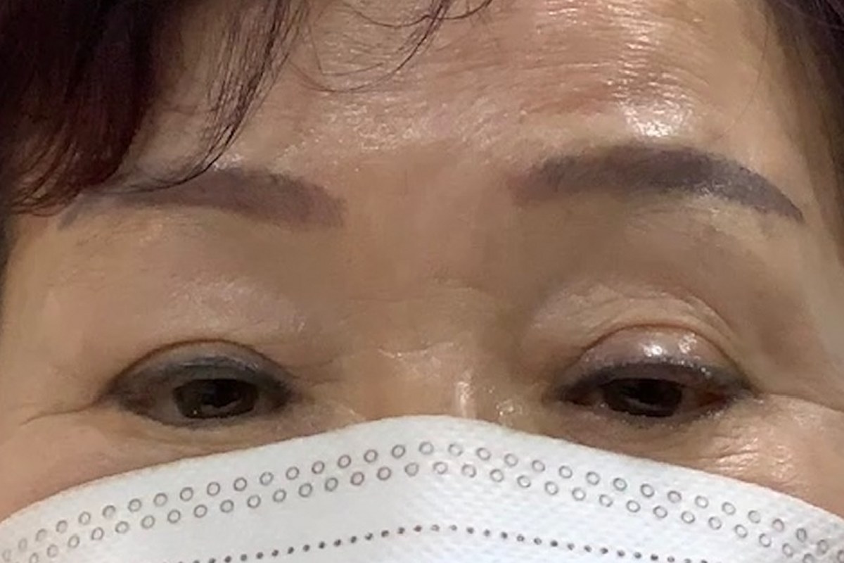 안검하수 교정 전