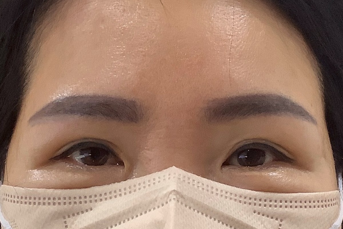 눈썹하거상 후