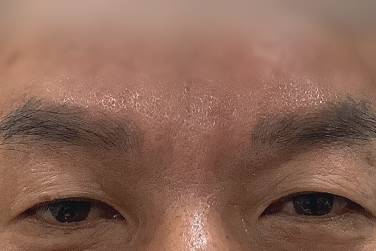 미간 주름 필러 후