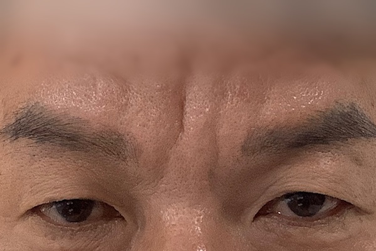 미간 주름 필러 전